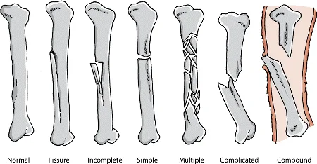 Types of bone fracture
