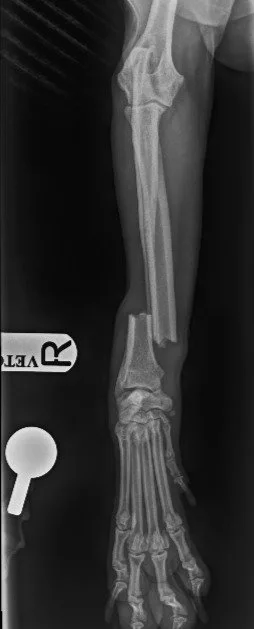 Archie radius fracture X-ray before surgery
